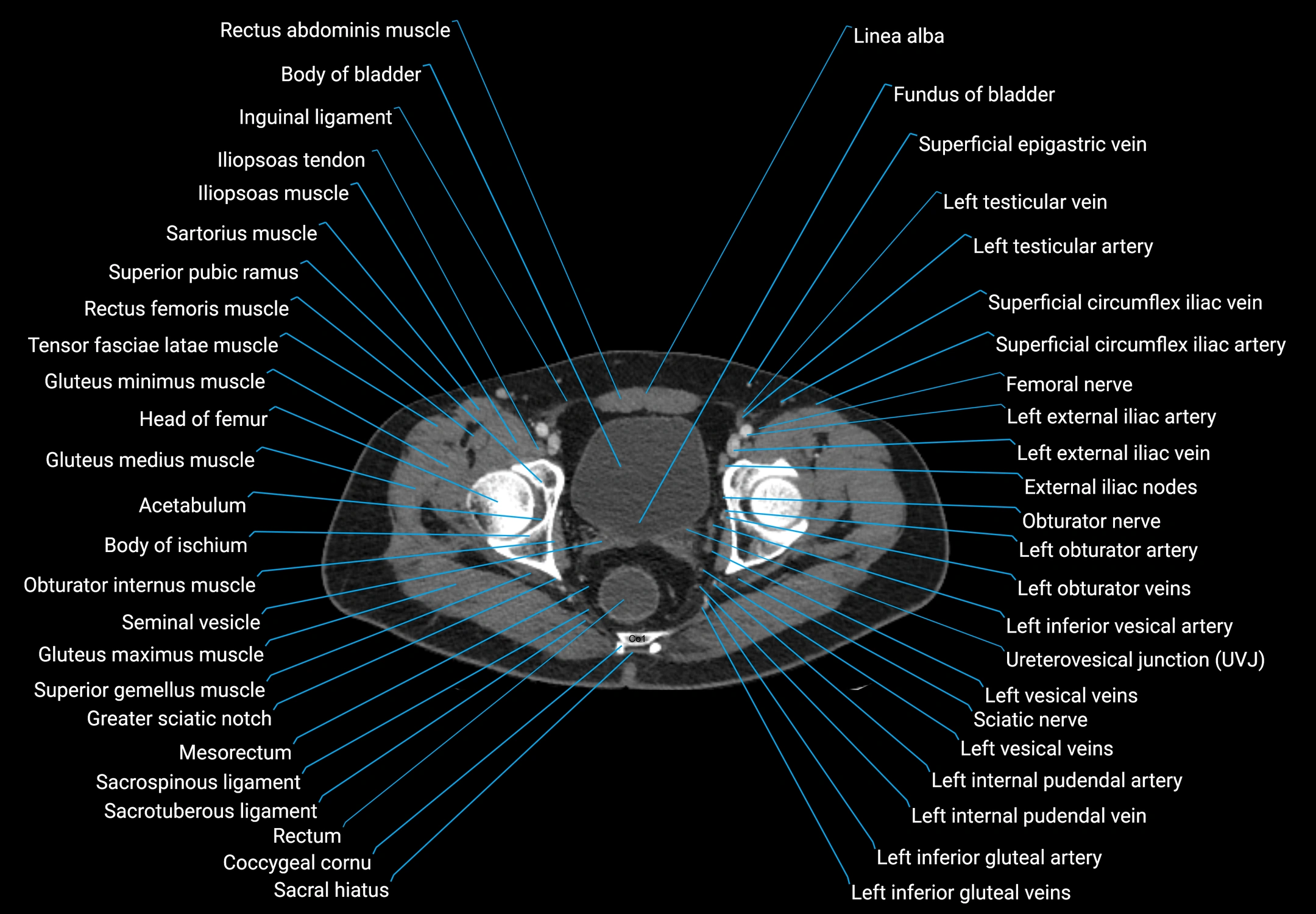 CT male pelvis axial cross sectional anatomy labelled radiology image -00182.webp